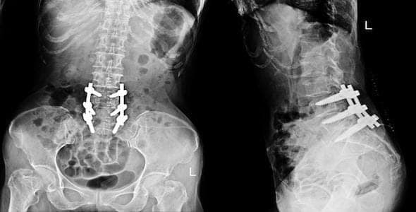 X-ray images reveal spinal implants in the lower back region, viewed from front and side, often crucial for assessing the extent of a spinal cord injury.
