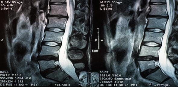 MRI scan of a human lumbar spine, potentially revealing trauma from a prior car accident alongside the detailed view of vertebrae and intervertebral discs.