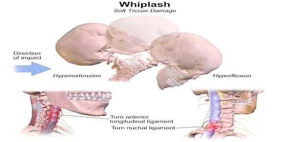 Medical illustration depicting a whiplash injury from a car accident. Two skull views illustrate hyperextension and hyperflexion. Close-ups reveal torn anterior longitudinal and nuchal ligaments, highlighting the impact on soft tissue injuries in the neck.